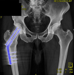 Hip Fracture With Pinning of Femur - CTisus CT Scan