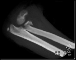 Radius and Ulnar Fractures - CTisus CT Scan