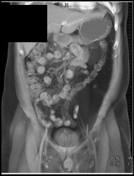 Lipoma Displaces Left Colon - CTisus CT Scan