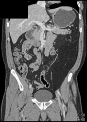 Lipoma Displacing the Descending Colon - CTisus CT Scan