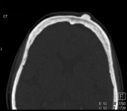 Osteoma in Skull - CTisus CT Scan