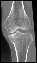 Tibial Plateau Fracture - CTisus CT Scan
