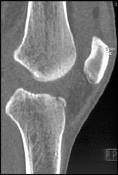 Tibial Plateau Fracture - CTisus CT Scan