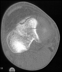 Tibial Plateau Fracture - CTisus CT Scan