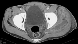 Abscess in Gluteal Muscles - CTisus CT Scan