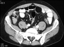 Metastatic Renal Cell Carcinoma - CTisus CT Scan