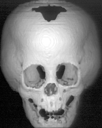 3D Circa 1982 - CTisus CT Scan