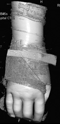 Abscess in Hand - CTisus CT Scan