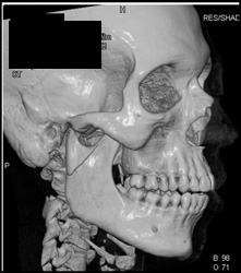 Mandibular Fracture - CTisus CT Scan