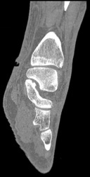 Ulcer in Ankle - CTisus CT Scan