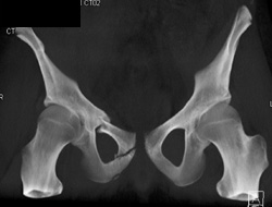 Symphysis Pubis Fractures - CTisus CT Scan
