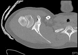 Fracture W/o Dislocation - CTisus CT Scan