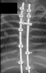 Spinal Hardware in 3D - CTisus CT Scan
