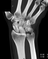 Trauma to Wrist - CTisus CT Scan