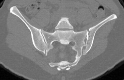 Destruction of Left SI Joint (infection) - CTisus CT Scan
