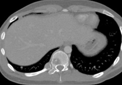 Metastatic Neuroblastoma - CTisus CT Scan