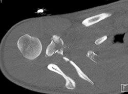 Scapular Fracture Due to GSW - CTisus CT Scan