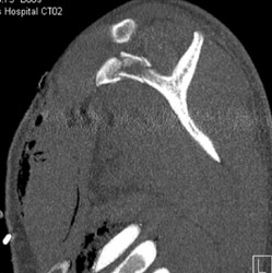 Scaplar Fracture - CTisus CT Scan