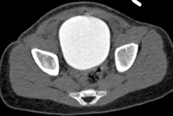 Ct Cystogram - CTisus CT Scan