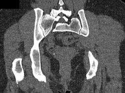Bleed Into Left Gluteal Muscle - CTisus CT Scan