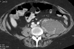 Psoas Abscess - CTisus CT Scan