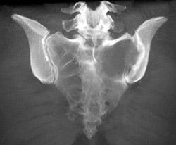 Metastatic Renal Cell Carcinoma - CTisus CT Scan