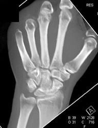 Scaphoid Fracture - CTisus CT Scan