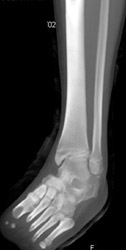Tibial Fracture - CTisus CT Scan