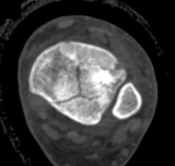 Tibial Fracture - CTisus CT Scan