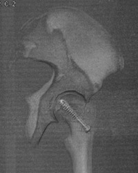 3D on Hip Pinning - CTisus CT Scan