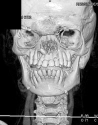 Alport Syndrome - CTisus CT Scan