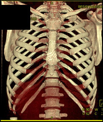 Normal Costal Cartilage - CTisus CT Scan