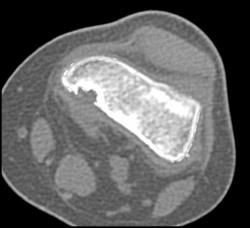 Fibrous Defect - CTisus CT Scan