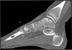 Talus Fracture - CTisus CT Scan