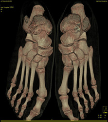 3D of the Foot - CTisus CT Scan