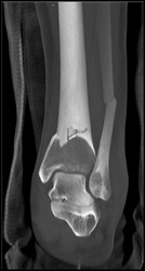 3D of Ankle Trauma - CTisus CT Scan
