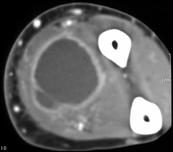 Abscess - CTisus CT Scan