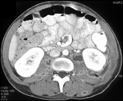 Intramuscular Abscess- Paraspinal Muscles - CTisus CT Scan