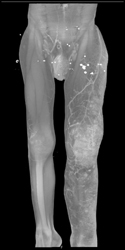 Klippel-Trenaunay-Weber (KTW) Syndrome Hemangiomas and Lymphangiomas - CTisus CT Scan