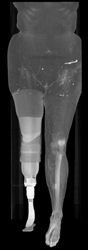 Below Knee Amputation (BKA) on Right - CTisus CT Scan