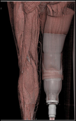 3D of Muscle and CTA - CTisus CT Scan