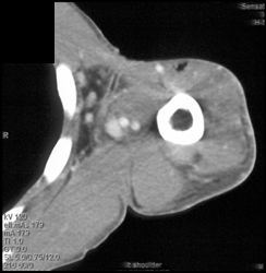 Abscess - CTisus CT Scan