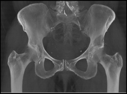 Lytic Lesion Acetabulum - CTisus CT Scan