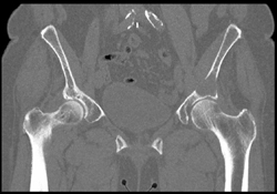 Lytic Lesion Acetabulum Due to Metastatic Lung Cancer - CTisus CT Scan