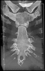 Variant of Sternal Anatomy - CTisus CT Scan