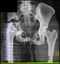 Post Hip Resection With Metal Implants - CTisus CT Scan