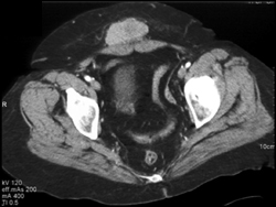 Metastases to Subcutaneous Tissues (lung Cancer Primary) - CTisus CT Scan