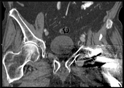 Small Pseudoaneurysm Lt Groin - CTisus CT Scan