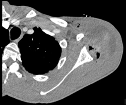 Abscess Left Shoulder - CTisus CT Scan