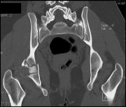 Acetabular Fracture - CTisus CT Scan